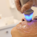 Exilis Ultra Facial